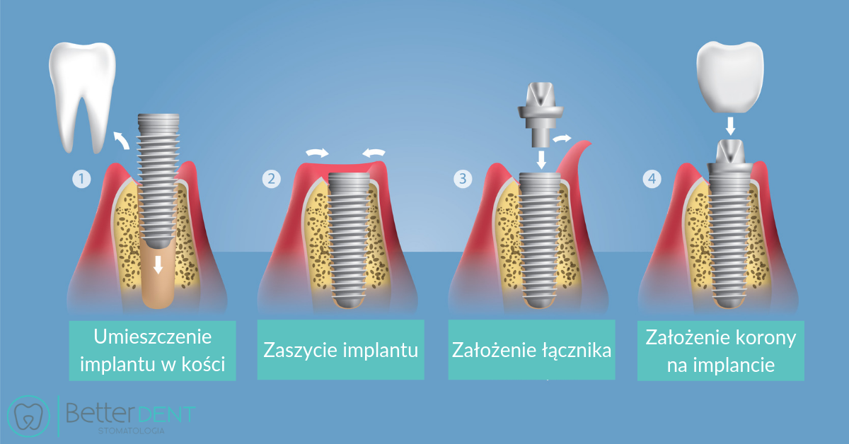 implanty zębowe jak wygląda leczenie