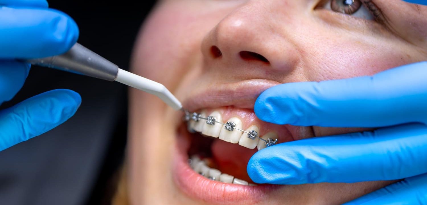 Odklei się zamek w aparacie ortodontycznym